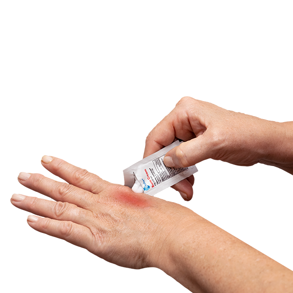 A person applies Globe First Aid Burn Cream 0.9g from a small packet to a red, irritated area on the back of their hand, with the box labeled "144 Packets" visible against a white background.