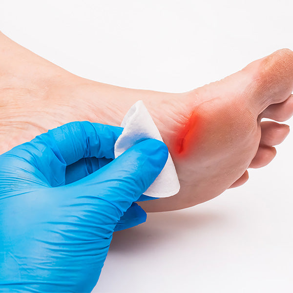 A hand in a blue medical glove cleans a bleeding cut on someone's foot using a Globe 3" x 3" Advanced Sterile Gauze Pad, ideal for wound care and first aid kits.